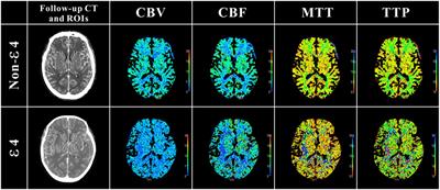 Apolipoprotein E ε4: A Possible Risk Factor of Intracranial Pressure and White Matter Perfusion in Good-Grade Aneurysmal Subarachnoid Hemorrhage Patients at Early Stage